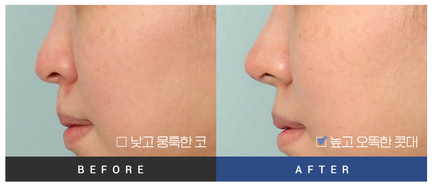 전후사진