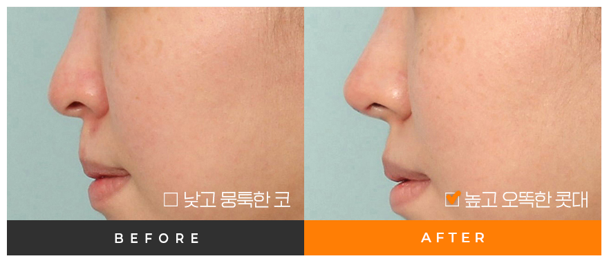 전후사진
