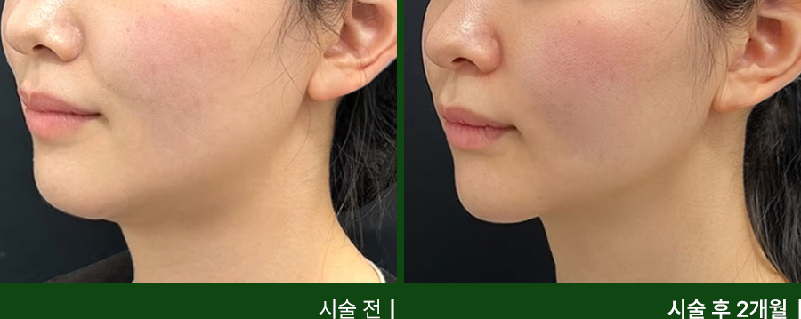 전후사진